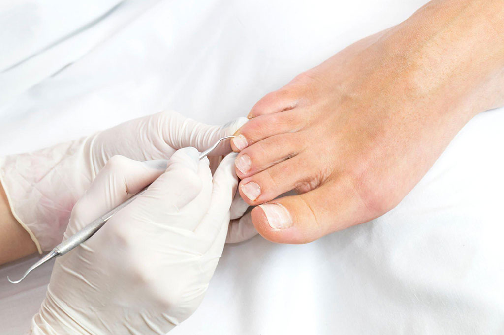 Onyfix Ingrown Toenail Correction - Leading Edge Podiatry